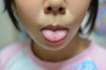 舌に出来た炎症を総括して舌炎