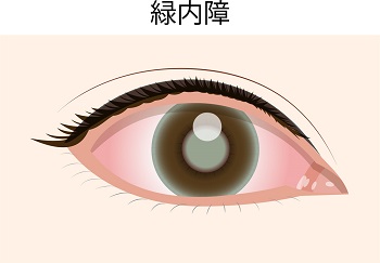 眼に眼圧以上の圧力がかかって視力が低下してしまう緑内障
