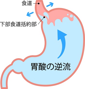 胃液や胆汁が食道に逆流しておこる食道炎