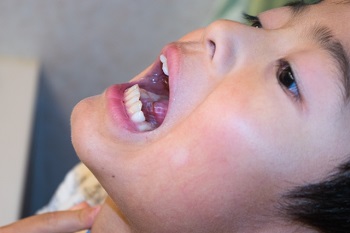 子供にみられる喉の感染症
