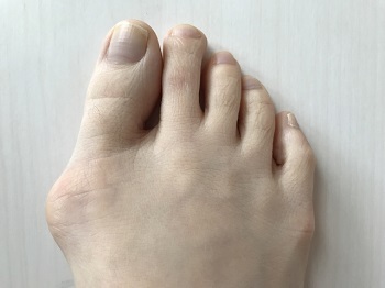 足の親指が曲がって関節が膨らむ外反母趾