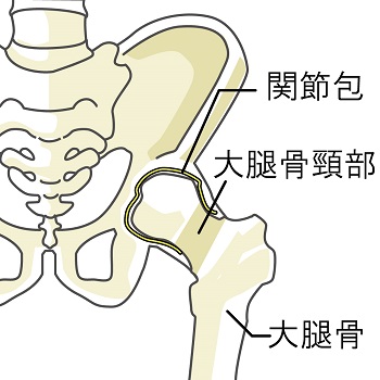 四肢の切断もあり得る骨に発生する代表的な悪性の腫瘍の骨肉腫